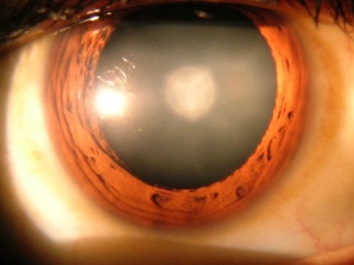 stem cells cataracts